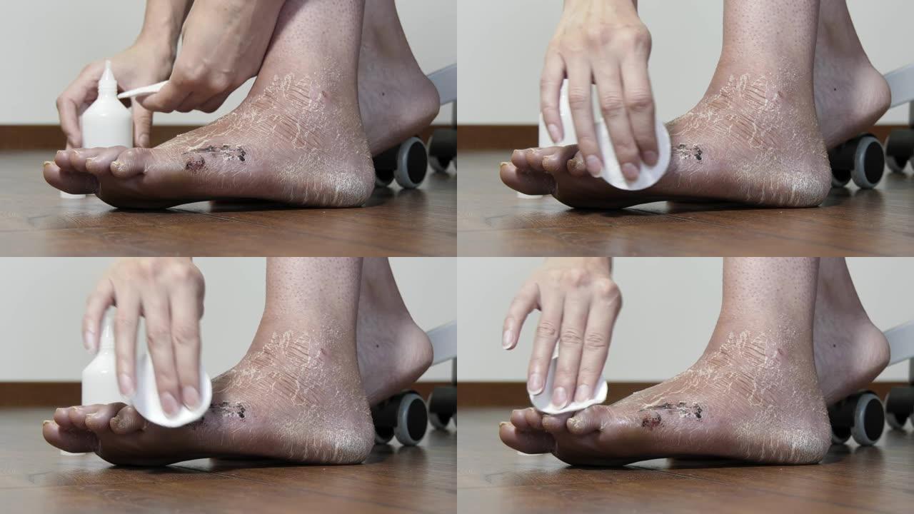 一名妇女在手术后用杀菌剂治疗疤痕。术后在脚，骨折后腿部缝合并去除石膏绷带后。