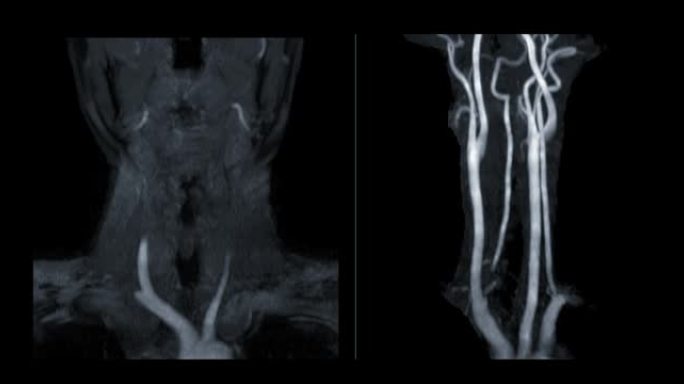 MRA颈动脉或颈部磁共振血管造影显示颈动脉。