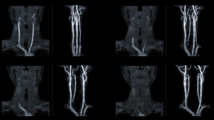 MRA颈动脉或颈部磁共振血管造影显示颈动脉。