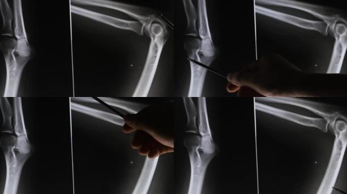 4k医生研究手臂、腿部关节的x光片进行分析医学健康医院