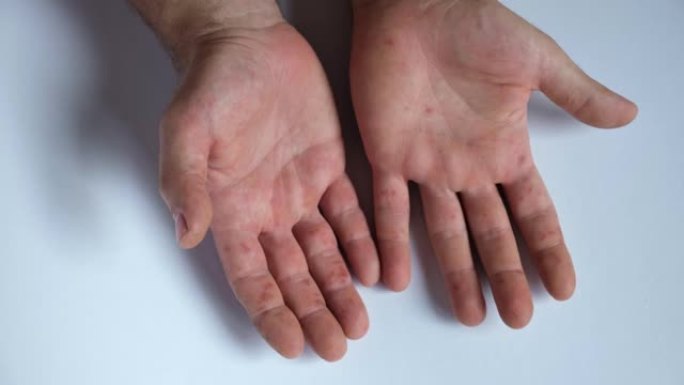 疼痛的皮疹，手上有红斑水泡。关闭过敏皮疹，人的手与皮炎，健康问题。病人皮肤湿疹。病毒性疾病。手掌、肠
