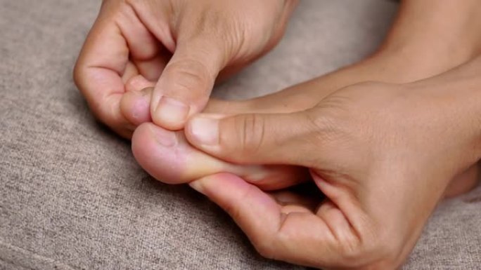 女性抱着痛苦的脚并按摩拇趾以减轻疼痛的特写镜头。大脚趾边缘的拇囊囊肿肿胀导致畸形 (拇外翻)。女人的