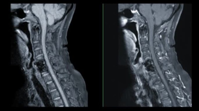 MRI C-脊柱或颈椎磁共振图像。