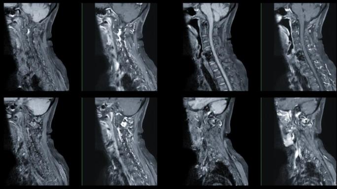 MRI C-脊柱或颈椎磁共振图像。