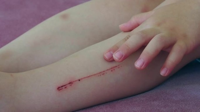 在腿上形成痕迹的划痕伤口，孩子的腿受伤了，