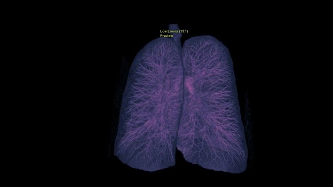 CT胸部或肺部3D渲染图像在屏幕上翻转以诊断结核病，结核病和新型冠状病毒肺炎。