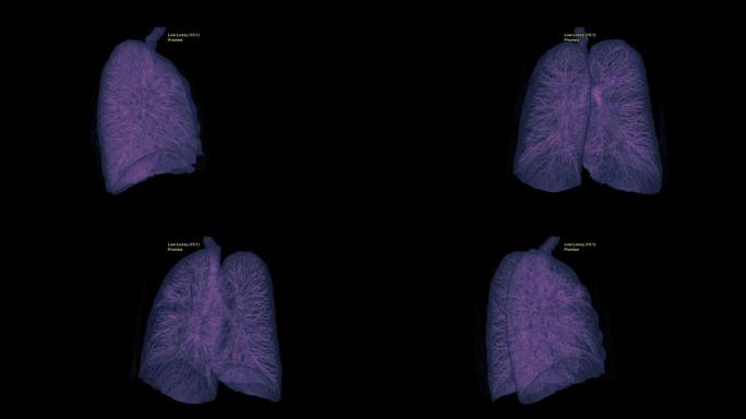 CT胸部或肺部3D渲染图像在屏幕上翻转以诊断结核病，结核病和新型冠状病毒肺炎。