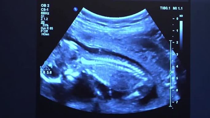 婴儿身体和脊柱的超声波。人类胚胎在超声波显示器上略微移动他的头。