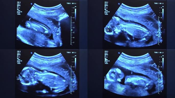 婴儿身体和脊柱的超声波。人类胚胎在超声波显示器上略微移动他的头。