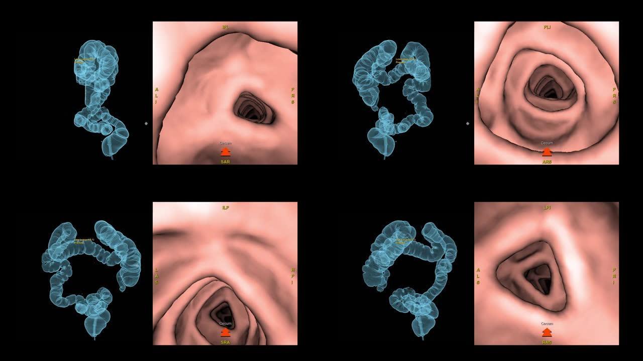 CT结肠造影三维渲染筛查大肠癌。检查结肠癌筛查。