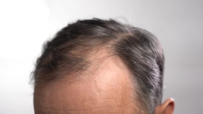 浅灰色背景上秃顶的男性头部特写。