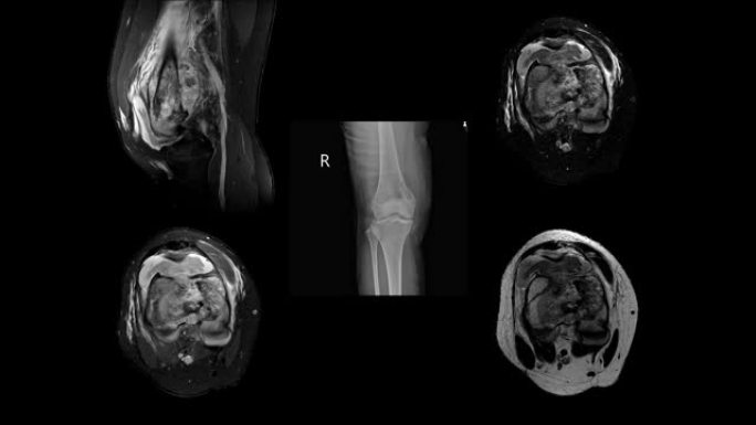 右膝病史的MRI: 一名15岁的女性出现右股骨病理性骨折