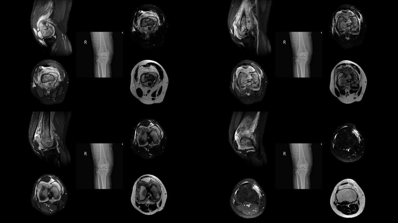 右膝病史的MRI: 一名15岁的女性出现右股骨病理性骨折