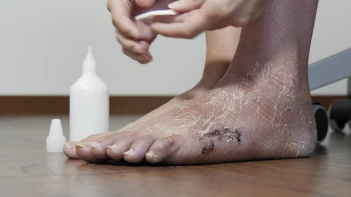一名妇女在手术后用杀菌剂治疗疤痕。术后在脚，骨折后腿部缝合并去除石膏绷带后。