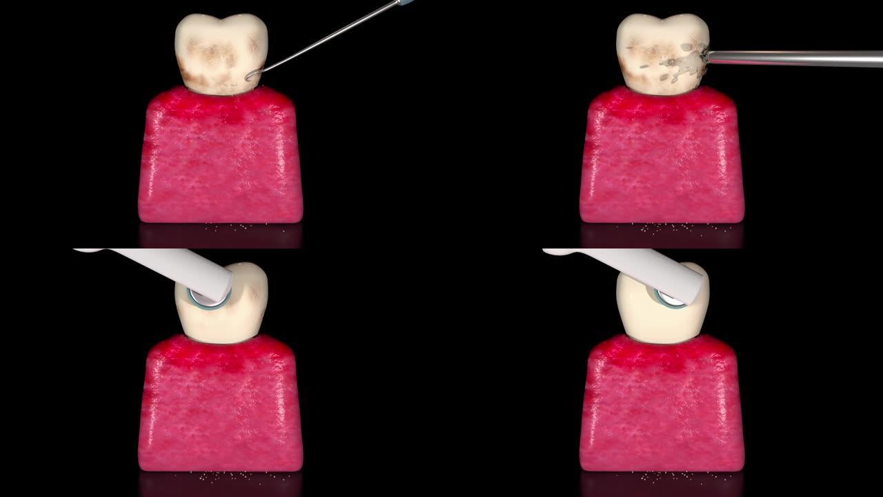 牙菌斑和牙垢去除