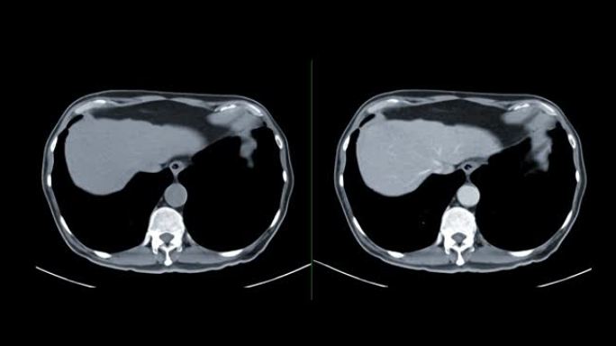 比较CT胸部或CT肺轴视非对比与打针造影剂对肺部疾病的诊断和新型冠状病毒肺炎。