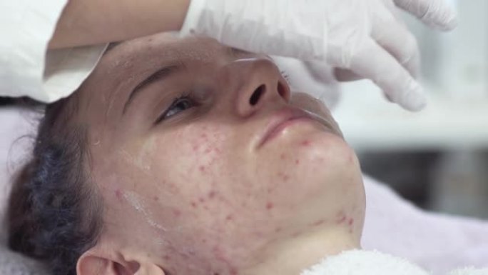 皮肤科医生或化妆品沙龙对年轻女性有问题的皮肤进行痤疮治疗