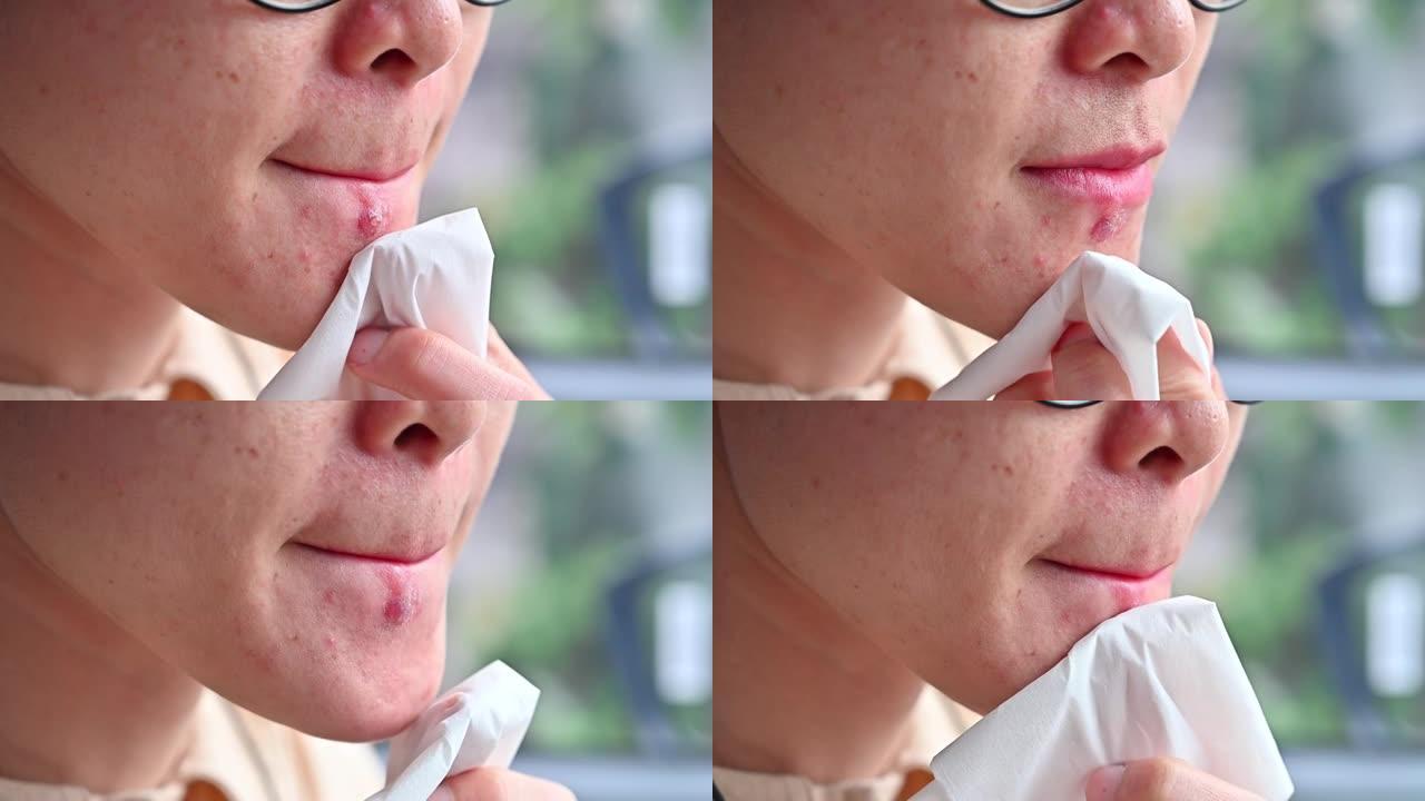 妇女使用薄纸清洁和吸收唇疱疹淋巴的镜头出现在她的下唇上。