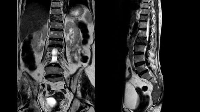 腰骶脊柱MRI
