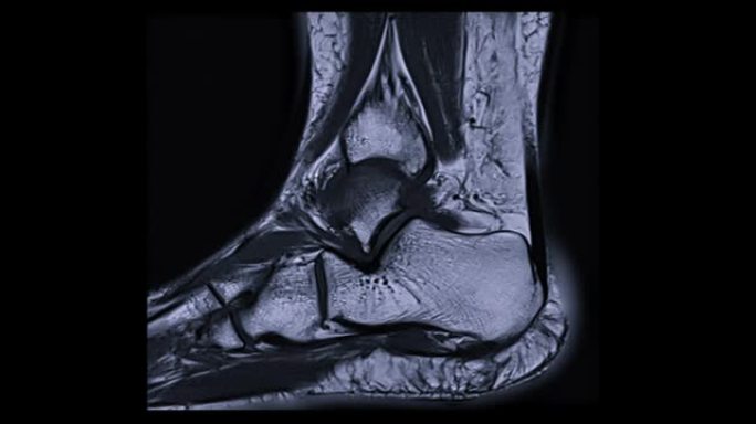 MRI踝关节矢状面PDW诊断足损伤肌腱。