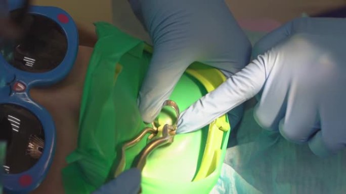 牙医使用围堰治疗儿童的龋齿和牙齿重建