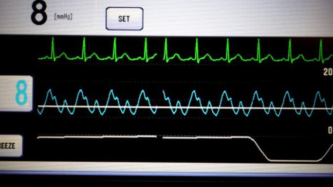 生命体征监测仪心电图视频素材
