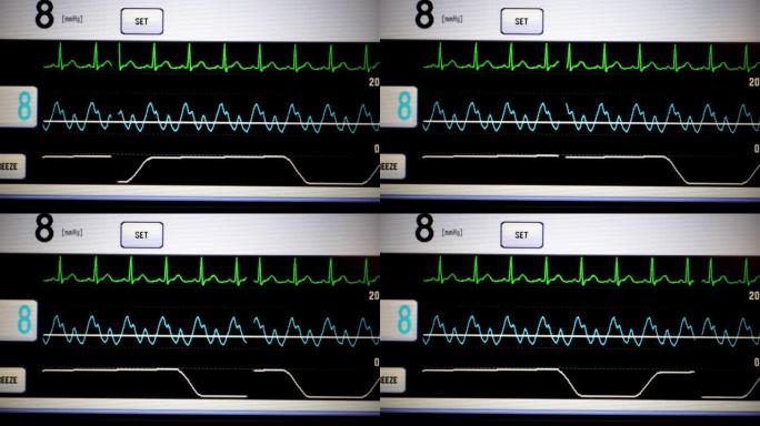 生命体征监测仪心电图视频素材