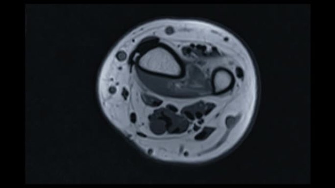 MRI腕关节诊断类风湿关节炎。