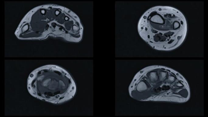 MRI腕关节诊断类风湿关节炎。