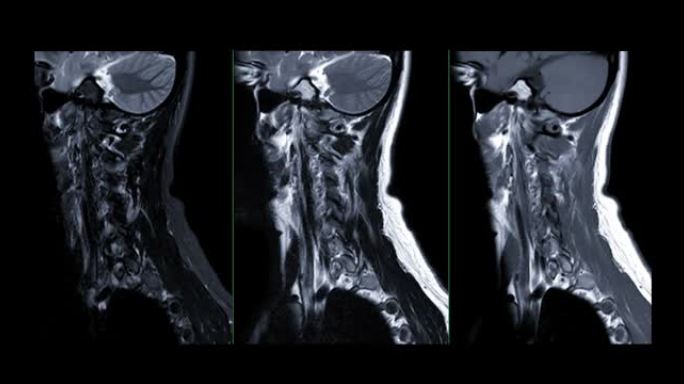 MRI C-脊柱或颈椎磁共振图像。