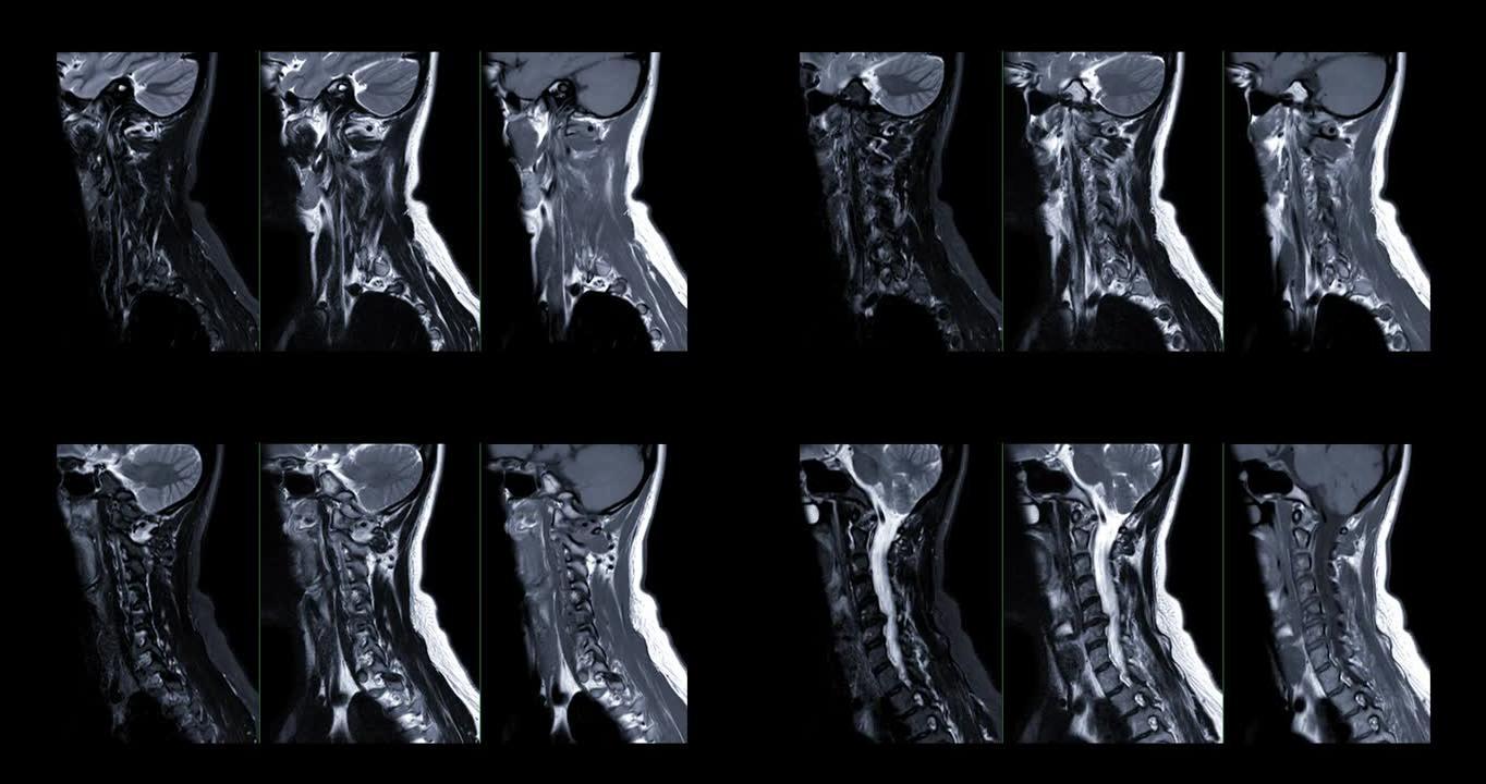 MRI C-脊柱或颈椎磁共振图像。