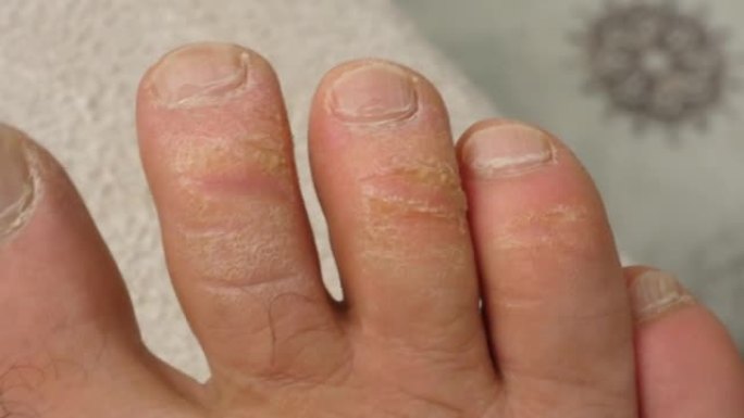 脚趾上的老茧和真菌病，被忽视的人的脚，