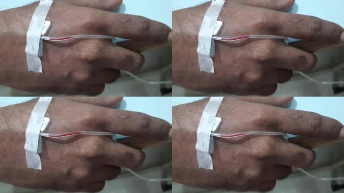 特写镜头从左向右移动，将输血IV贴在患者手臂上
