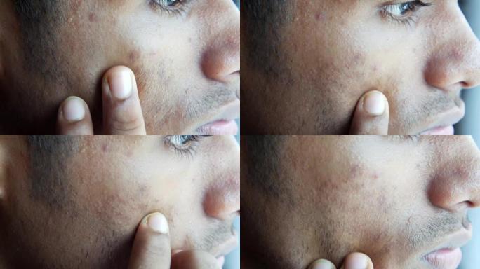 年轻人脸上有皮肤问题的特写。