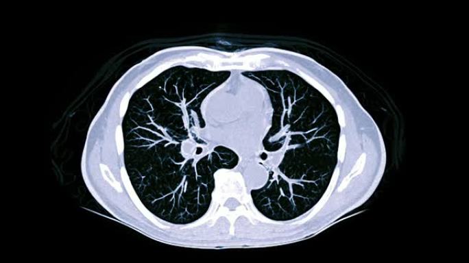 CT胸部或肺部轴向mip视图用于诊断TB，结核病和新型冠状病毒肺炎。