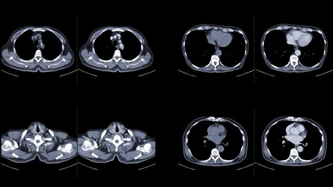 比较CT胸部或CT肺轴视非对比与打针造影剂对肺部疾病的诊断和新型冠状病毒肺炎。