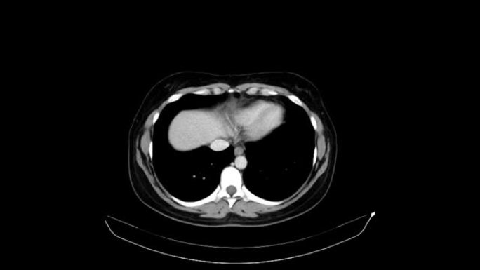 一名40岁女性的腹部和骨盆的CT与静脉对比。轴向视图。高压阶段。系列说明5.0 B41s.