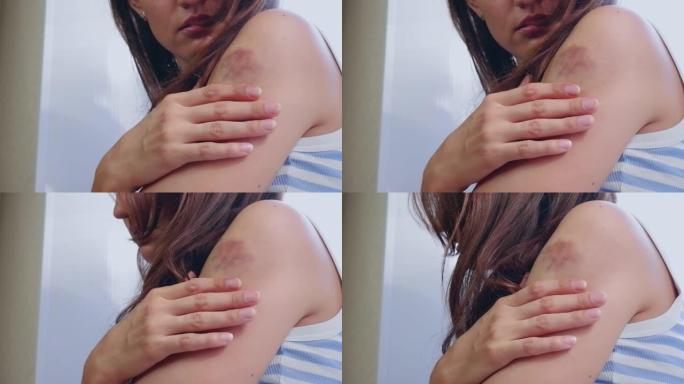 一名身穿白色和蓝色t恤的妇女，手臂上有瘀伤，坐在窗边特写镜头时用手触摸伤口。