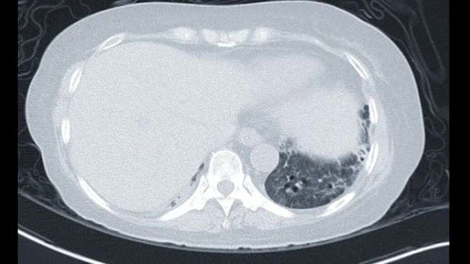 CT胸部或CT肺轴mip视图显示感染新型冠状病毒肺炎后的肺。