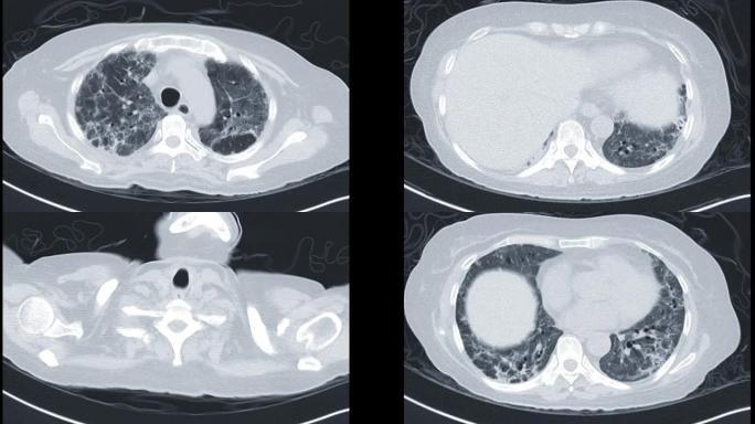CT胸部或CT肺轴mip视图显示感染新型冠状病毒肺炎后的肺。