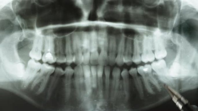 全景牙科x光的特写。笔指向下颌区域智齿的异常位置