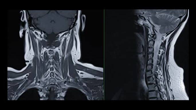 MRI C-脊柱或颈椎磁共振图像。