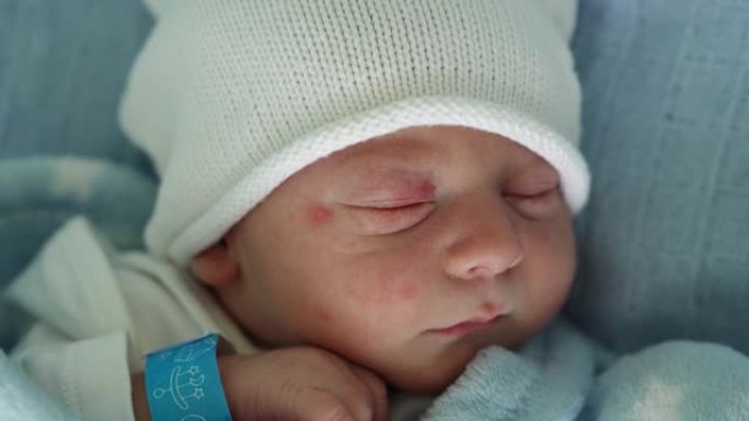 初生婴儿脸部肖像痤疮过敏刺激早期睡在蓝色背景上。孩子在帽子上生命的开始。婴儿，分娩，出生的最初时刻，