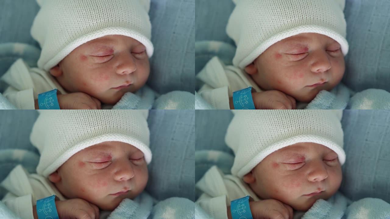 初生婴儿脸部肖像痤疮过敏刺激早期睡在蓝色背景上。孩子在帽子上生命的开始。婴儿，分娩，出生的最初时刻，