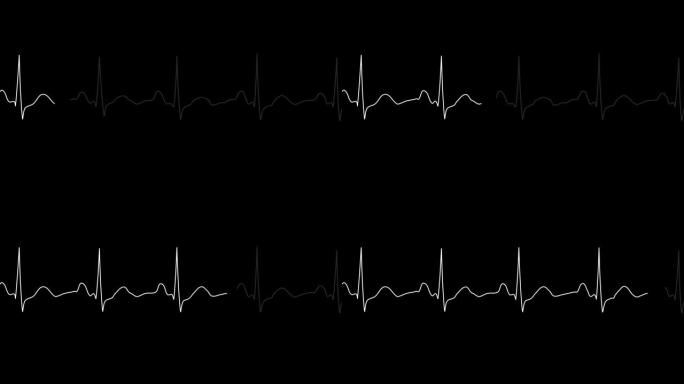 巴布亚新几内亚阿尔法。心电图监视器。循环心电图。正常窦性心律。心率。类型2