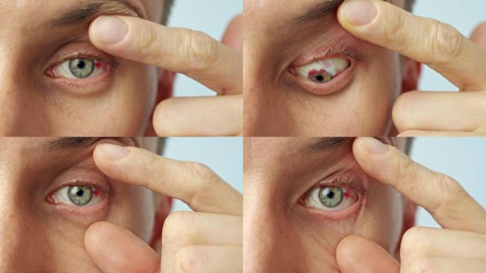 一个男人的眼睛酸痛的特写镜头，用手指张开