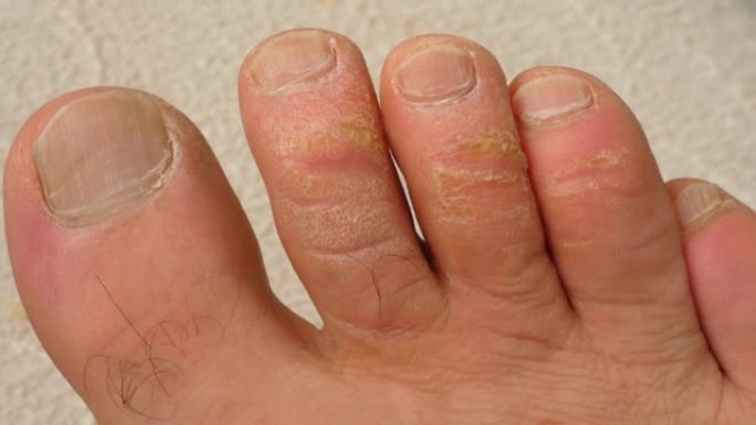 脚趾上的老茧和真菌病，被忽视的人的脚，