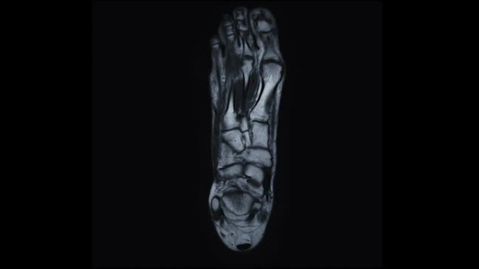 MRI足部冠状PDW用于诊断足部损伤的肌腱。