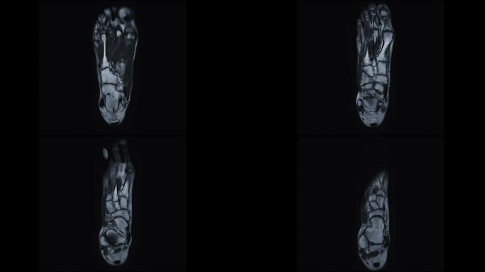 MRI足部冠状PDW用于诊断足部损伤的肌腱。