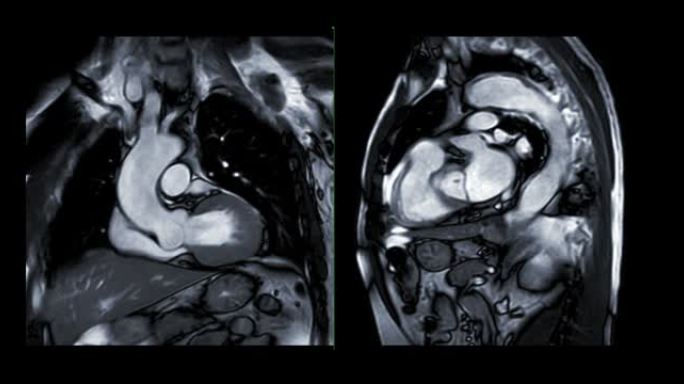 MRI心脏或心脏MRI (磁共振成像) 显示心脏跳动以检测心脏病。